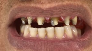 CORONAS-DIENTES-antes