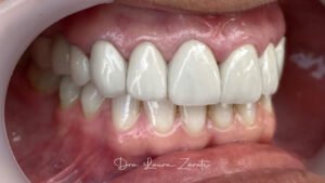 CORONAS-DIENTES-despues