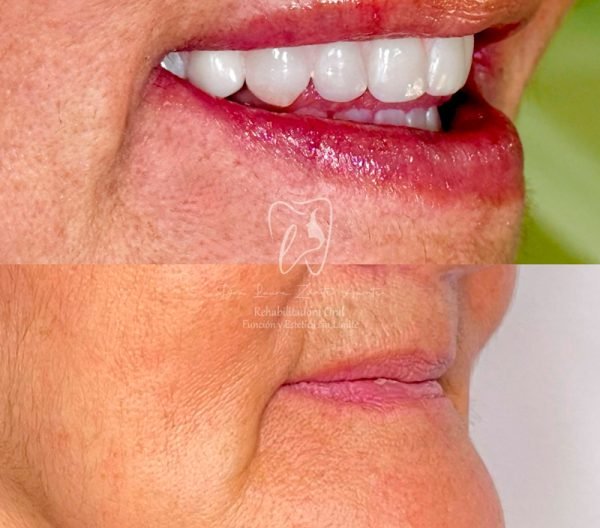 Testimonio-2A-protesis-hibrida