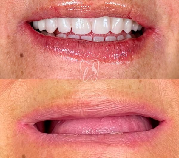 Testimonio-2B-protesis-hibrida