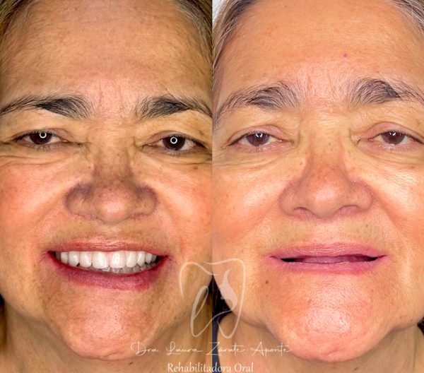 Testimonio-2C-protesis-hibrida