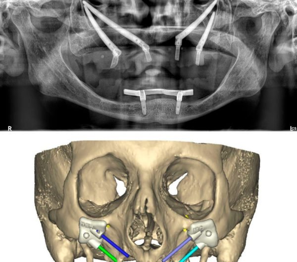 Testimonio-2D-protesis-hibrida